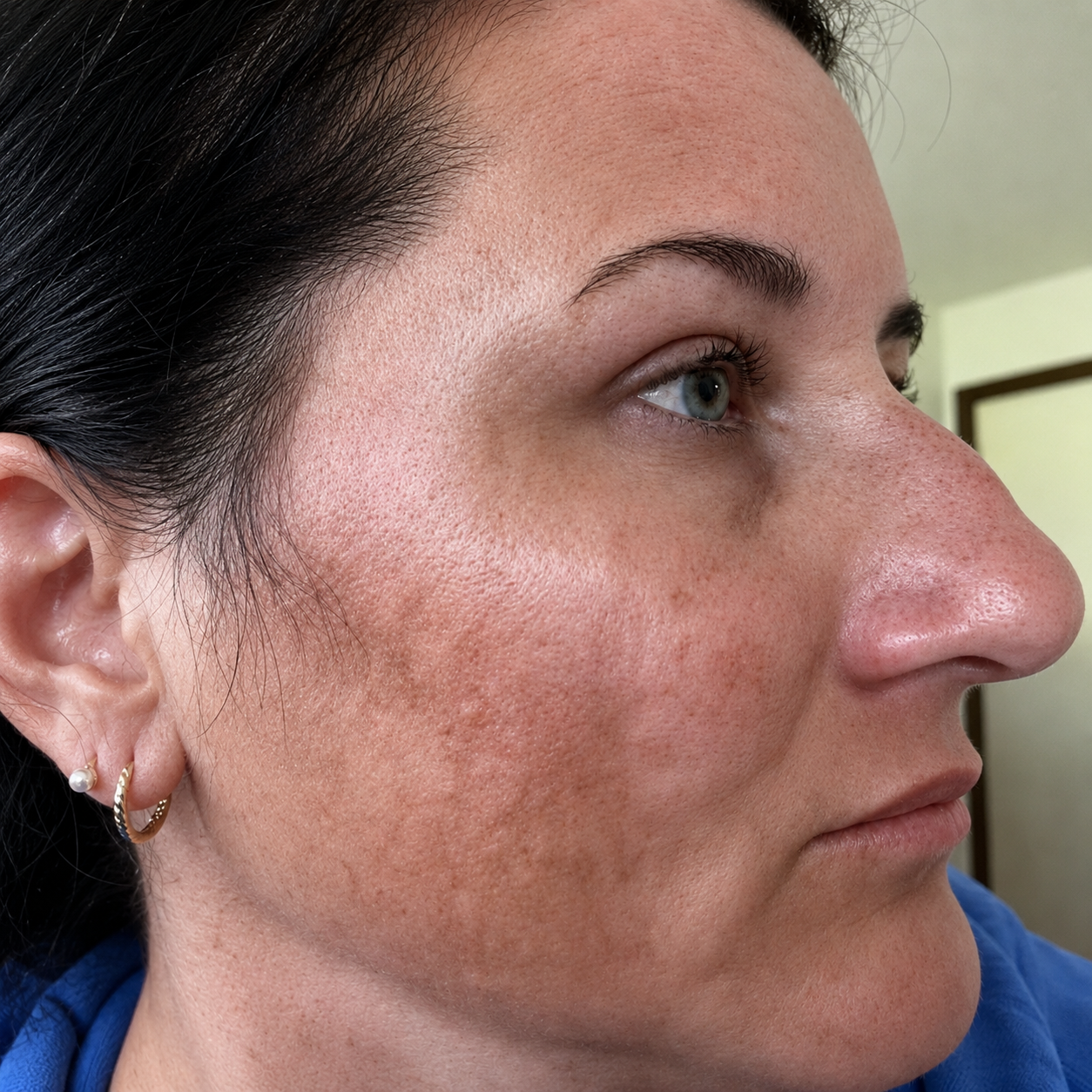 Kojic Acid Niacinamide Whitening Serum Dark Spot Remover Brightening Cream Freckle Mask Fade Acne Scars Melasma Dull Skin